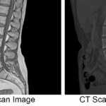 Mri Vs Ct Scan Diagnosing Spine Neck Injuries Degenerative Diseases Joseph Spine