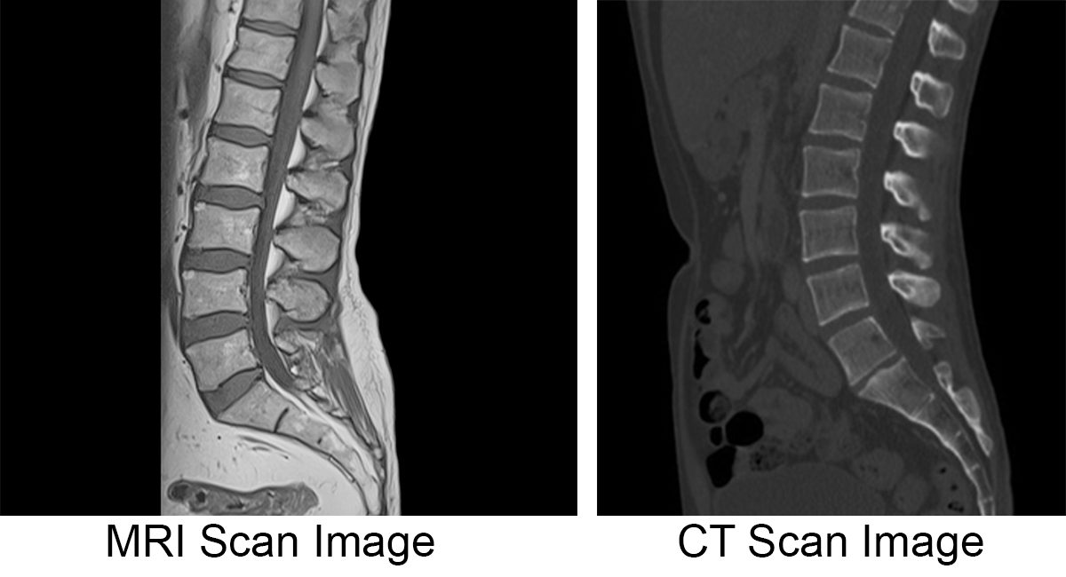 MRI vs. CT Scan; Spine & Neck Injuries & Degenerative Diseases | Joseph Institute