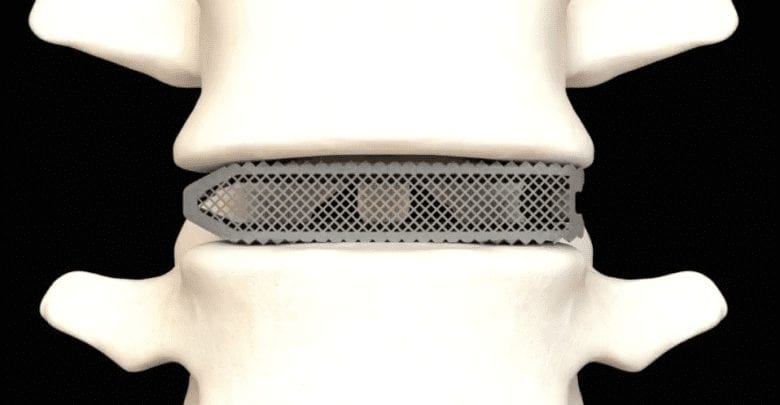 FDA Approved Medical Device for Spinal Fusion