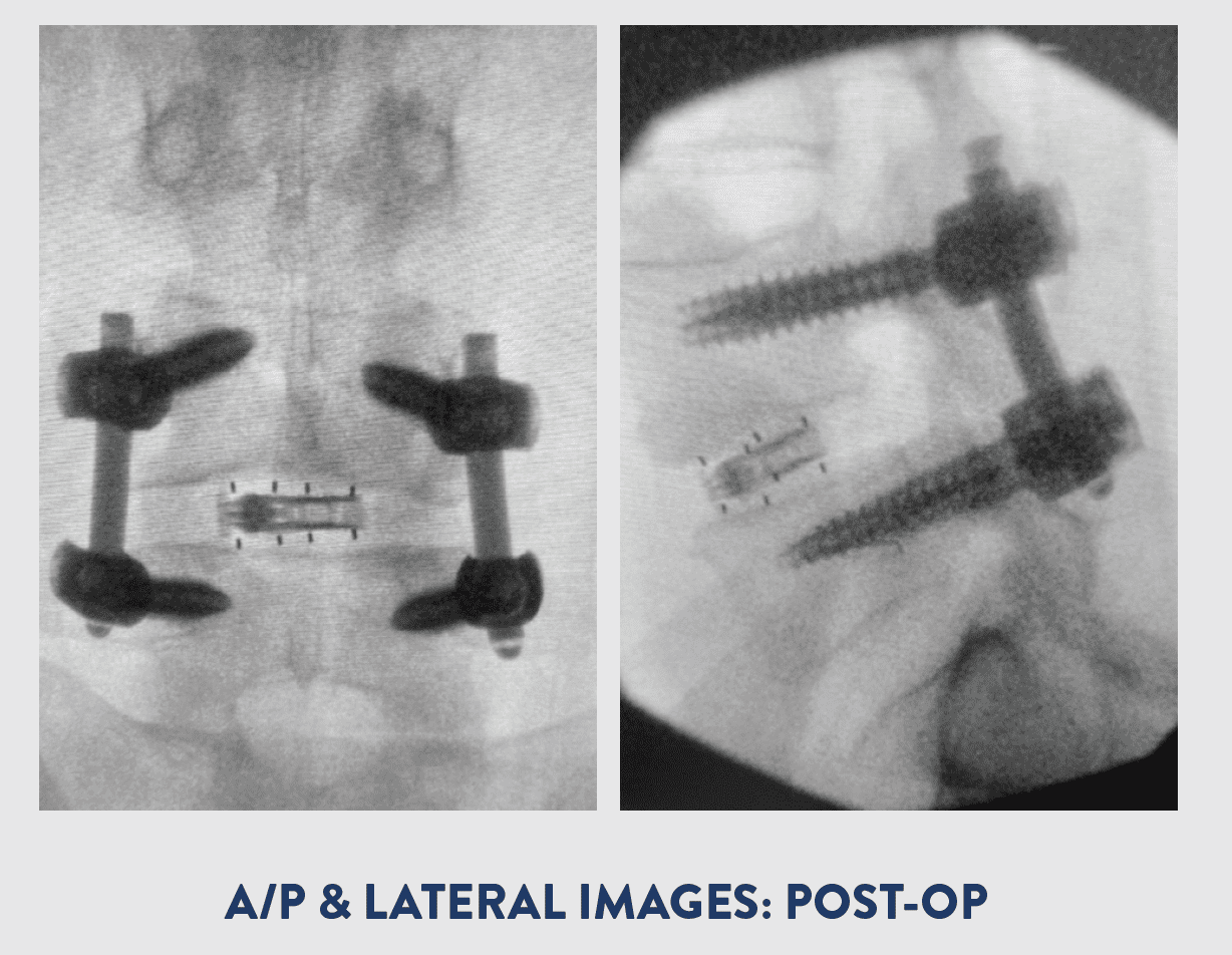 Endoscopy | Joseph Spine Institute