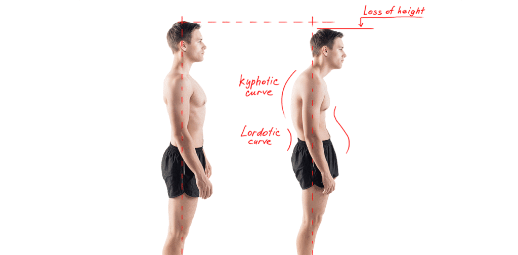 kyphosis | Joseph Spine Institute