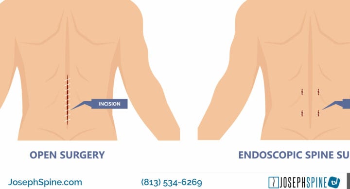 minimally invasive spine surgery tampa bay